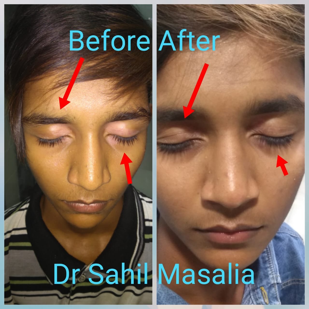 Vitiligo patient result
