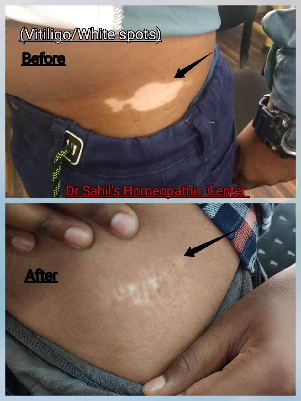 Skin result