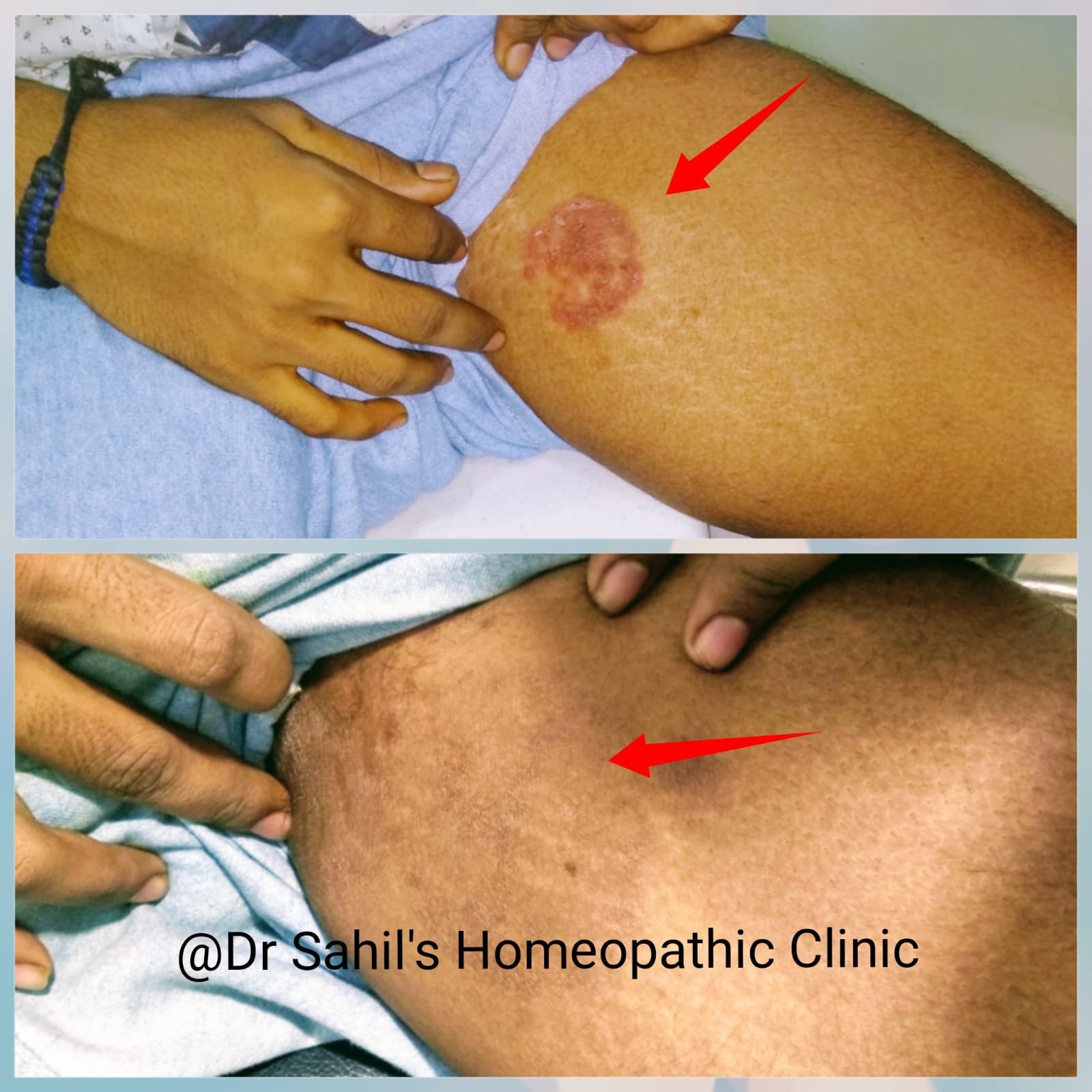 Skin result