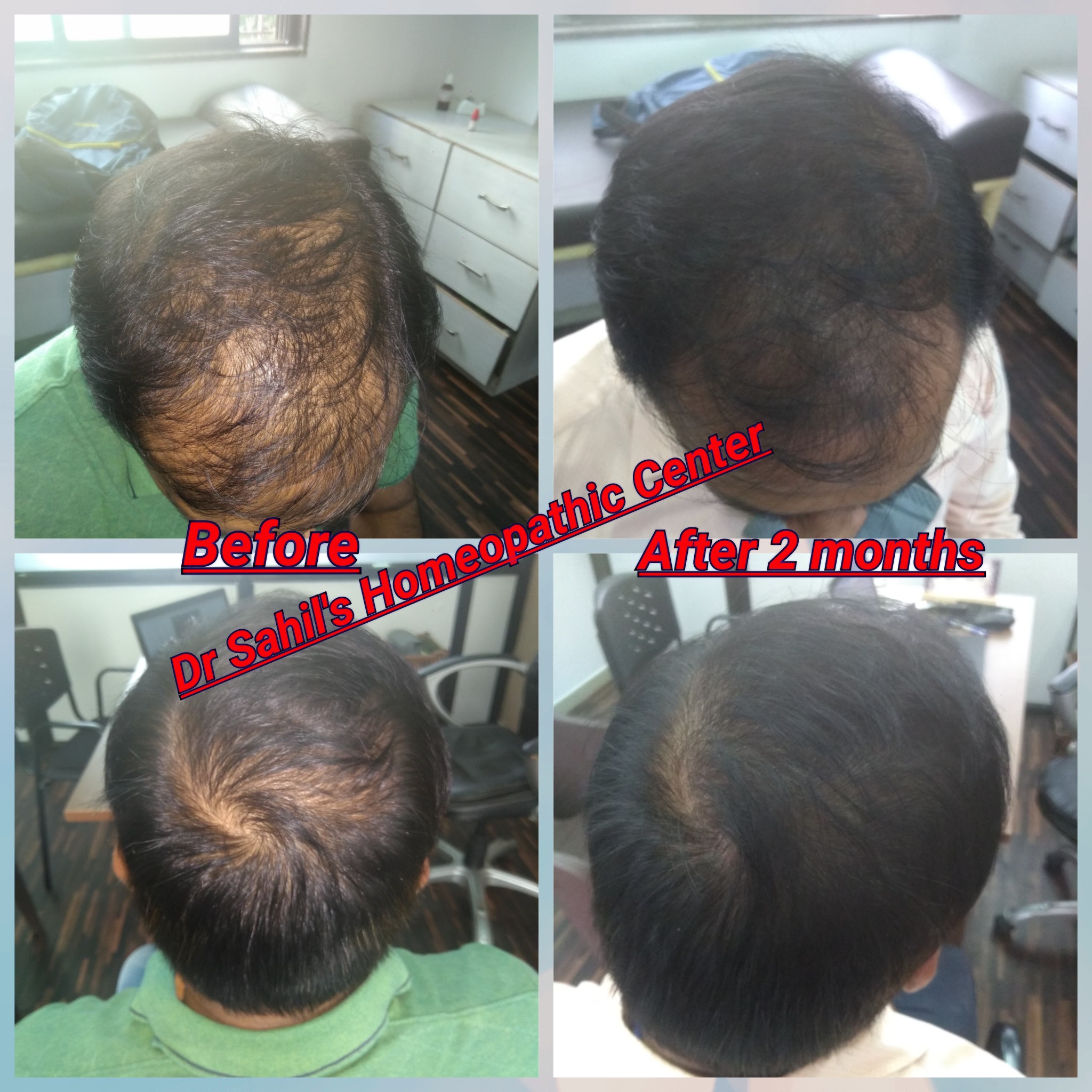 Alopecia result