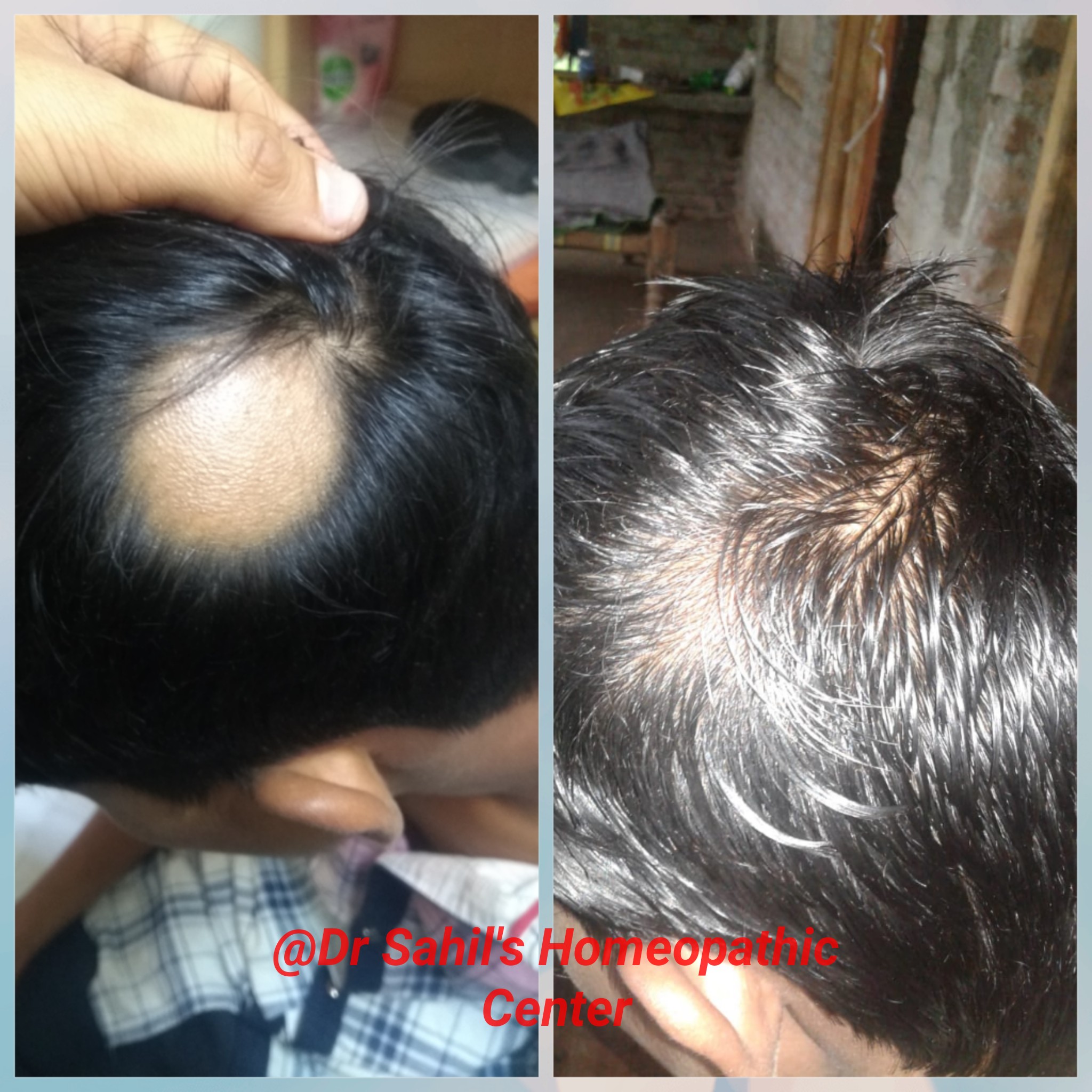 Alopecia result