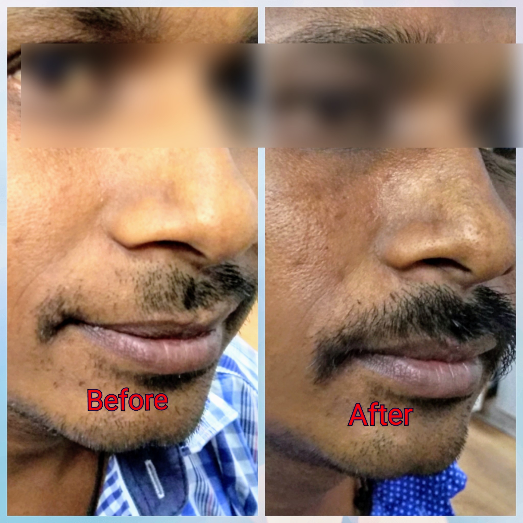 Alopecia result